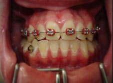 Featured image of post Freio De Cavalo Aparelho Dental